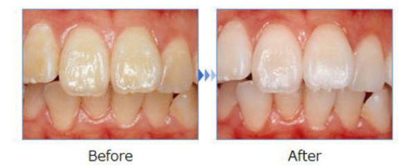 ホワイトニング症例１